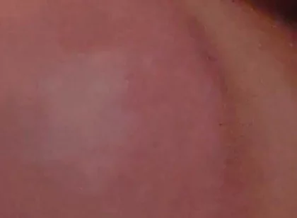 Immense Phimosis Being Extracted Cum and Précum.