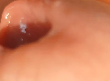The Great Transformation of Phimosis Elastica.