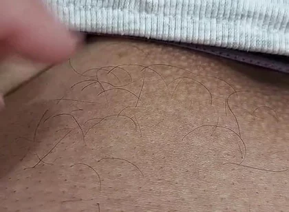 The Hair on My Penis - Led Hair Removal