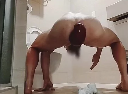 Enlargment Prolapse