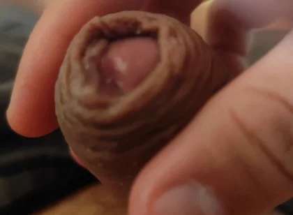 Great Phimosis Getting in the Way of the Boy's Orgasm