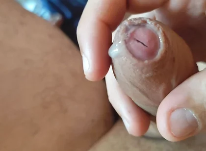 Dilation of the Corpus Cavernosum Exposes Spongy Foreskin.
