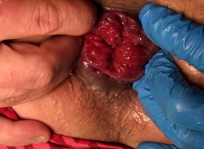 Finger in My Prolapse