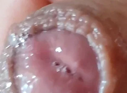 Deep Split in the Glans Produces Bubbling Liquid