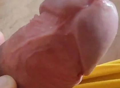 Scarred Frenulum Causes Glans Erection!