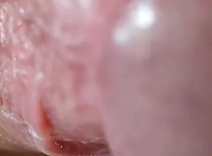 Opening the Scar of the Rough Frenulum!