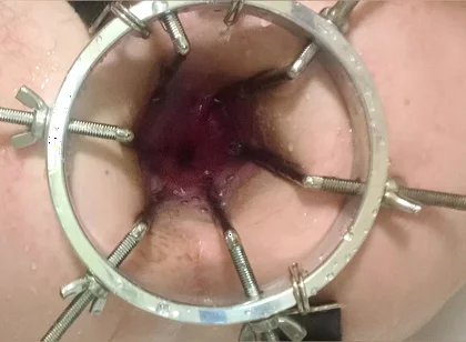 Enema, Anal Shower. Close-up View Through Anal Mirror. Anal with Water. Filling Anal with Water