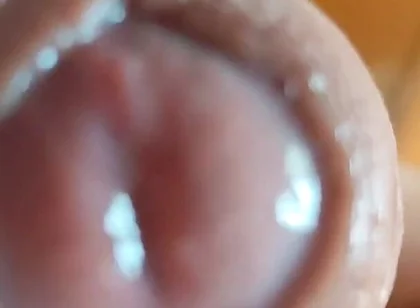 The Glans Appears Crowning Inside the Phimosis.