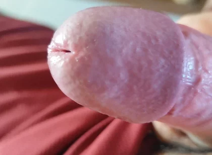 The Blossoming of Extensive Elastic Phimosis.