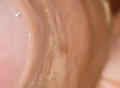Large Cheese Accumulated in Close up of Glans