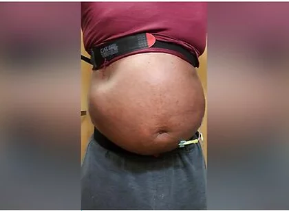 N2o Belly Inflation