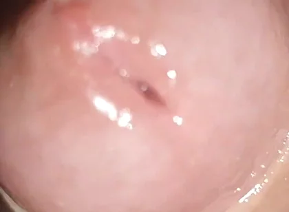 Maximum Dilation of Phimosis Cumming.