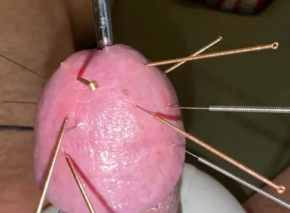 Acupuncture - Orgasm!