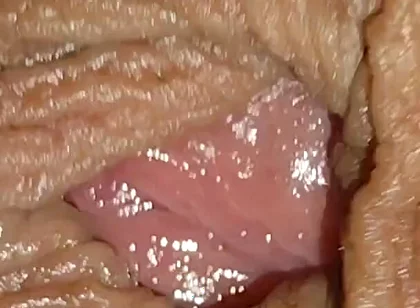 Boy with Large Anal Phimosis Excited!