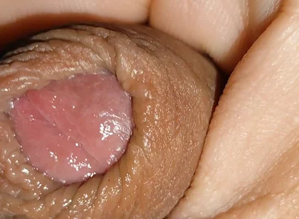 Boy with Large Anal Phimosis Excited!