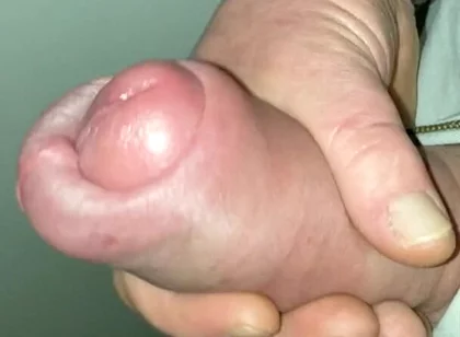 Huge Cock Pumped Foreskin Jerk off