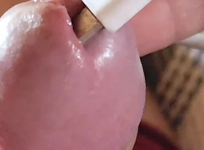 Applying Electric Shocks Inside the Glans.