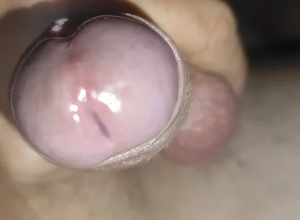 Scrotal Phimosis Results in an Extremely Hot Orgasm.